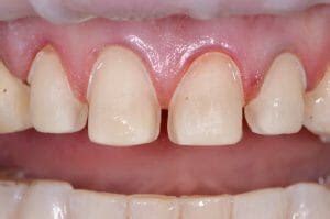 Anterior Veneer Preparation Design - Restorative Nation