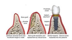 Ridge Augmentation – Levenson Periodontal Associates