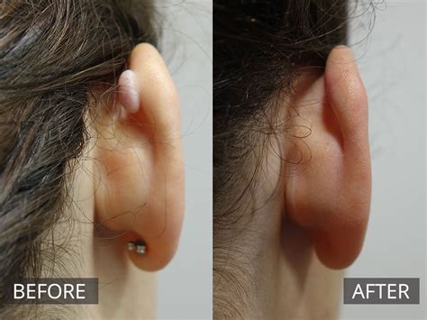 Keloid Scar Removal Treatment | The DOC Clinic Melbourne