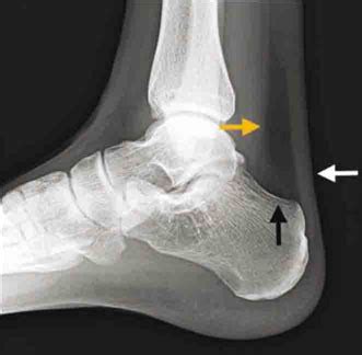 Achilles Tendon Tear Mri