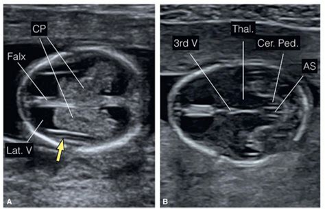 The Fetal Central Nervous System | Radiology Key