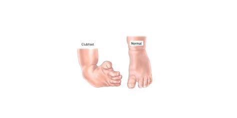 Congenital Talipes Equinovarus (Clubfoot) Nursing Management - RNpedia