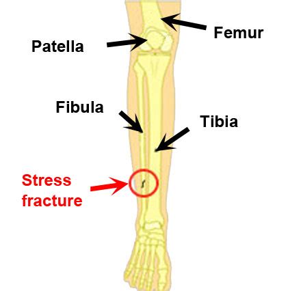 Fibula Hairline Fracture