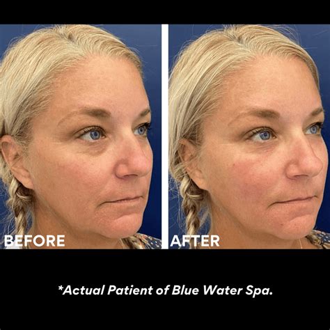 PRF Eye Area Rejuvenation | PRP Injections at Blue Water Spa