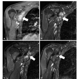 MRI of the right shoulder showing the tumor extent at the time of ...