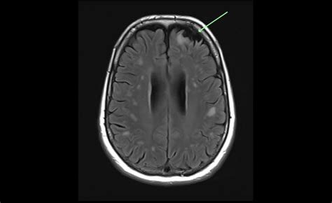 White Matter Hyperintensities on MRI - Artefact or Something Sinister?