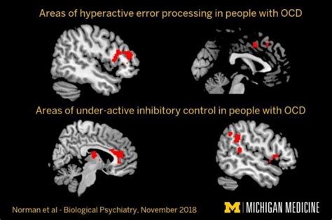 What Causes OCD?: Brain Scans Suggest Sufferers Have 'Inefficient' Links