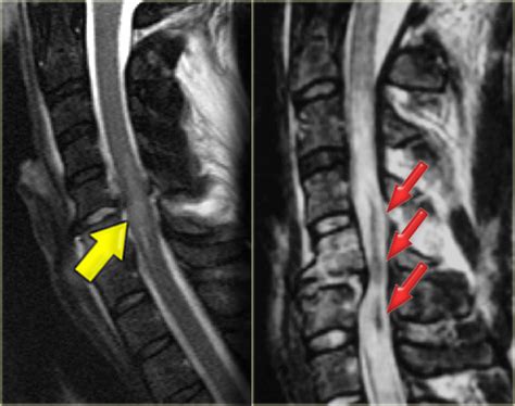 The Radiology Assistant : Cervical injury