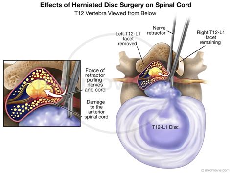 Medmovie.com | Herniated disc surgery at T12-L1 causing nerve damage