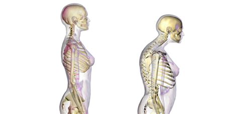 Goal-Directed Treatment for Osteoporosis: A Progress Report | Orthopedics This Week