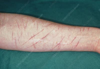 Self-inflicted wounds on arm - Stock Image - M330/0644 - Science Photo ...