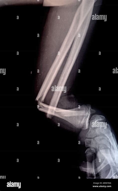 Compound Fracture X Ray