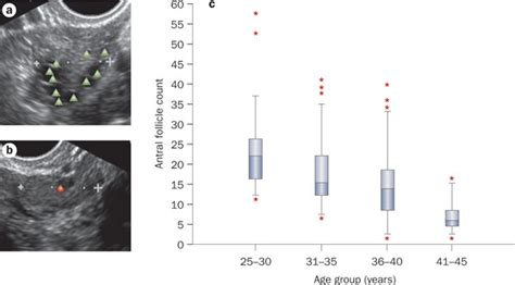 Antral follicle count.Transvaginal ultrasound images reflect a | high ...