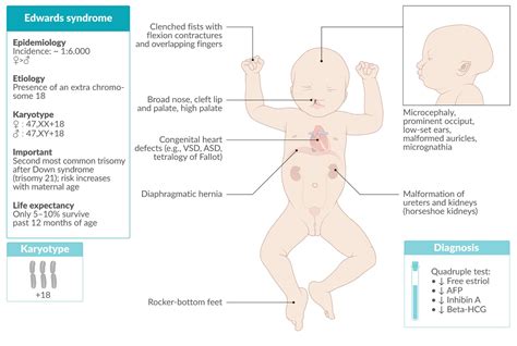 Edward Syndrome Symptoms Of Edward Syndrome Cause Of Edward, 45% OFF