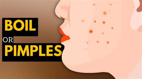 Boils vs. Pimples: What's the Difference and How to Treat Them - YouTube