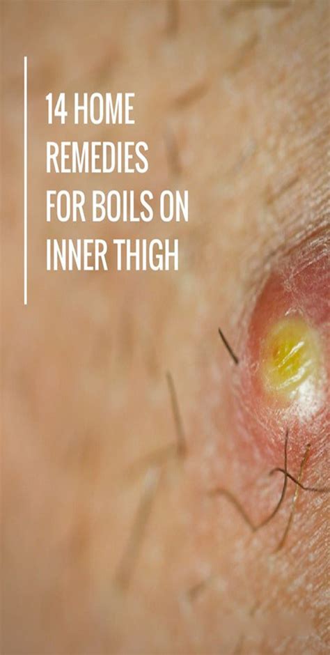 A boil is a common skin problem that may occur at any part of the body such as on ear, thighs ...