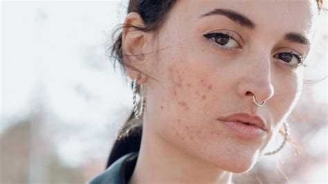 How to Deal with a Skin Allergy Outbreak Stat - FASHION Magazine