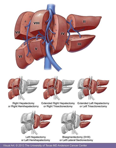 Liver Cancer Treatment | MD Anderson Cancer Center