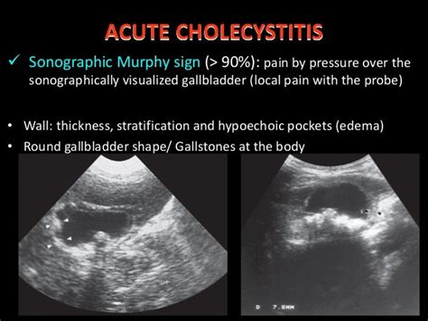 Ultrasound in acute abdominal pain