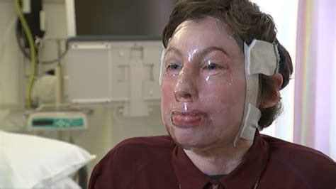 Exclusive: 96pc burns victim proud of remarkable recovery | ITV News ...