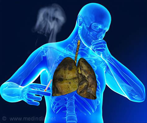 CAUSES AND PREVENTION OF TUBERCULOSIS - Health GadgetsNG