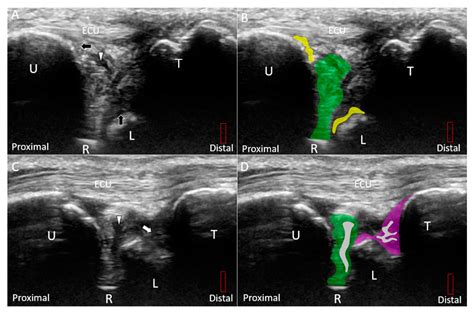 Wrist Ligament Ultrasound