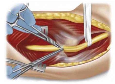 Peripheral Nerve Surgery Specialist | Adelaide Neurosurgery Centre