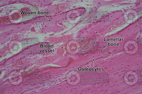 Woven Bone Histology