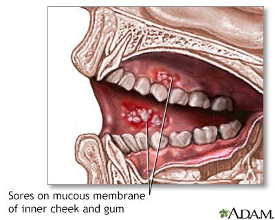 Mouth ulcers Information | Mount Sinai - New York