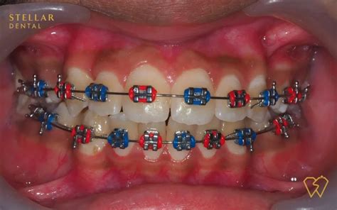 Braces Colors: Top Picks For 2023 - Stellar Dental