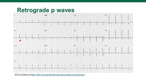 SVT on the ECG! — USF Emergency Medicine