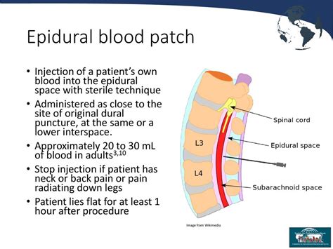 Epidural Blood Patch