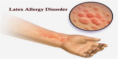 Non Latex Glove Allergy Symptoms - Images Gloves and Descriptions ...