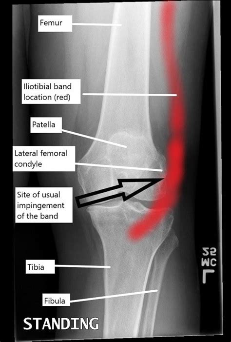 Iliotibial Band Syndrome - Complete Orthopedics | Multiple NY Locations