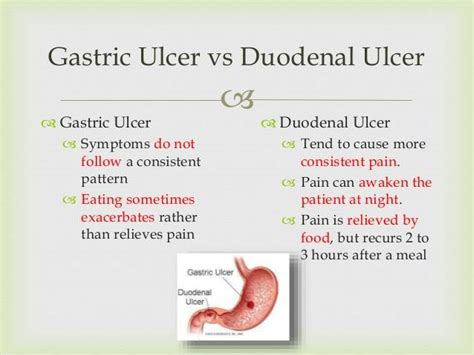 Duodenal Ulcer Pain Location