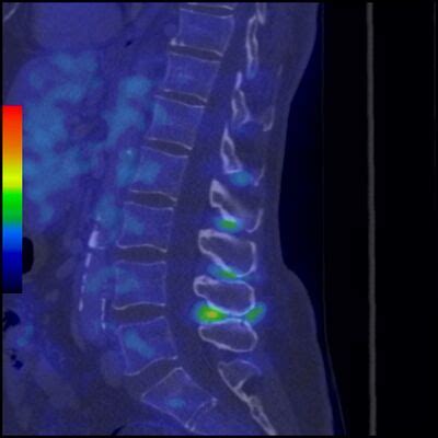 Baastrup Syndrome - Physiopedia