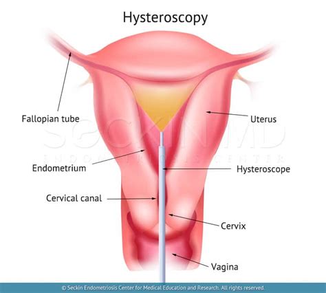 Hysteroscopy: Procedure, Uses, and Recovery Time