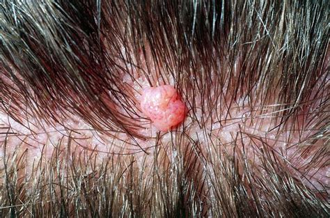 Close-up Of A Benign Mole On Scalp Of Young Man Photograph by Dr P ...