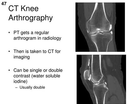 PPT - ARTHROGRAMS RT 255 PowerPoint Presentation - ID:548850