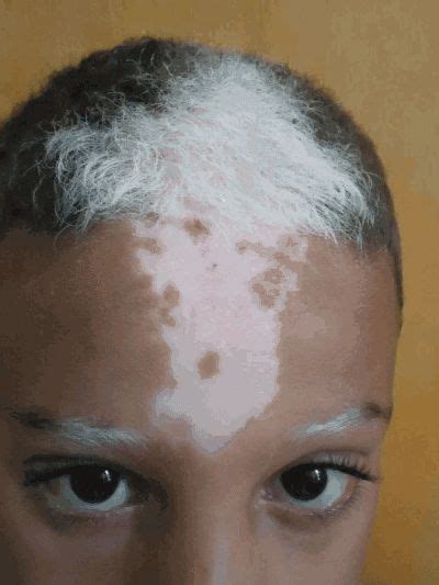 The soul is bone — Piebaldism is a condition characterized by the... | Skin, Poliosis, Vitiligo