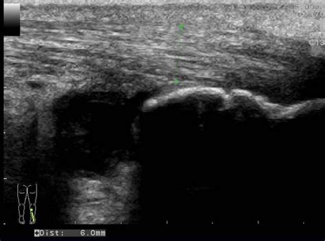 Achilles Tendon Injury Ultrasound