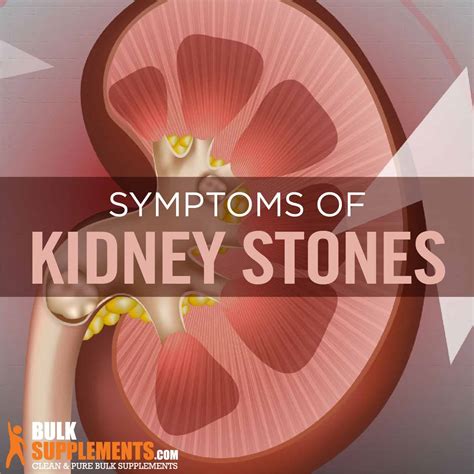 Kidney Stones: Symptoms, Causes & Treatment