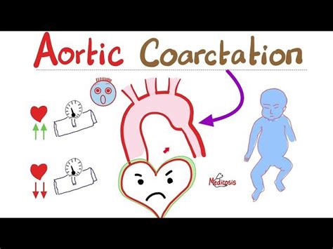 Free Video: Coarctation of the Aorta - Cardiology Series - Types ...