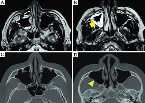 MRI and CT images suggest acute sinusitis. (A,B) Axial views of the... | Download Scientific Diagram