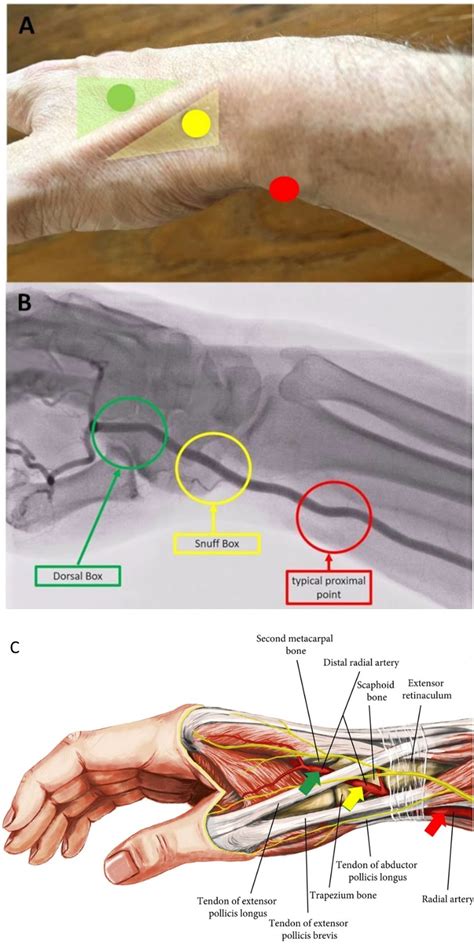 Arterial Accesses in Coronary Angiography and Intervention—Review with a Focus on Prognostic ...