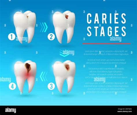 Tooth decay 3d vector poster. Teeth on different stages of dental ...