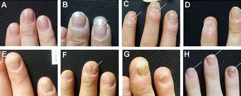 Frontiers | Predicting the Risk of Psoriatic Arthritis in Plaque ...