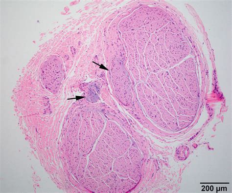 Nerve Biopsy Evaluation | Neupsy Key