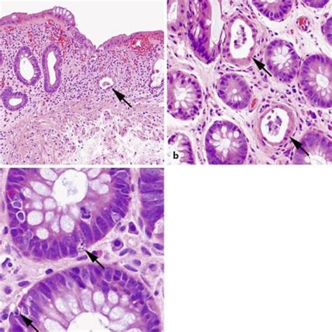 Sigmoidoscopy showing erythematous mucosa with ulceration in the... | Download Scientific Diagram