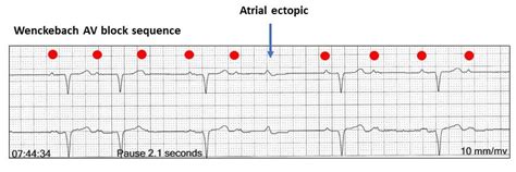 How would you interpret this ECG - Resources